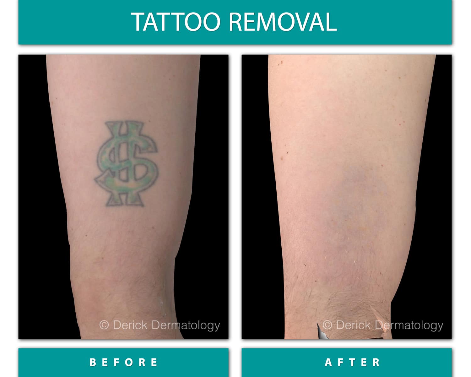 Faces of South Tampa  Cynosure PicoSure Tattoo Removal  Laser Technology   Aesthetic Laser