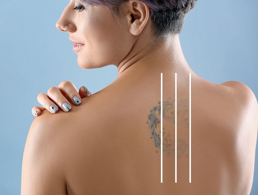 Does Laser Tattoo Removal Hurt  Pulse Light Clinic London