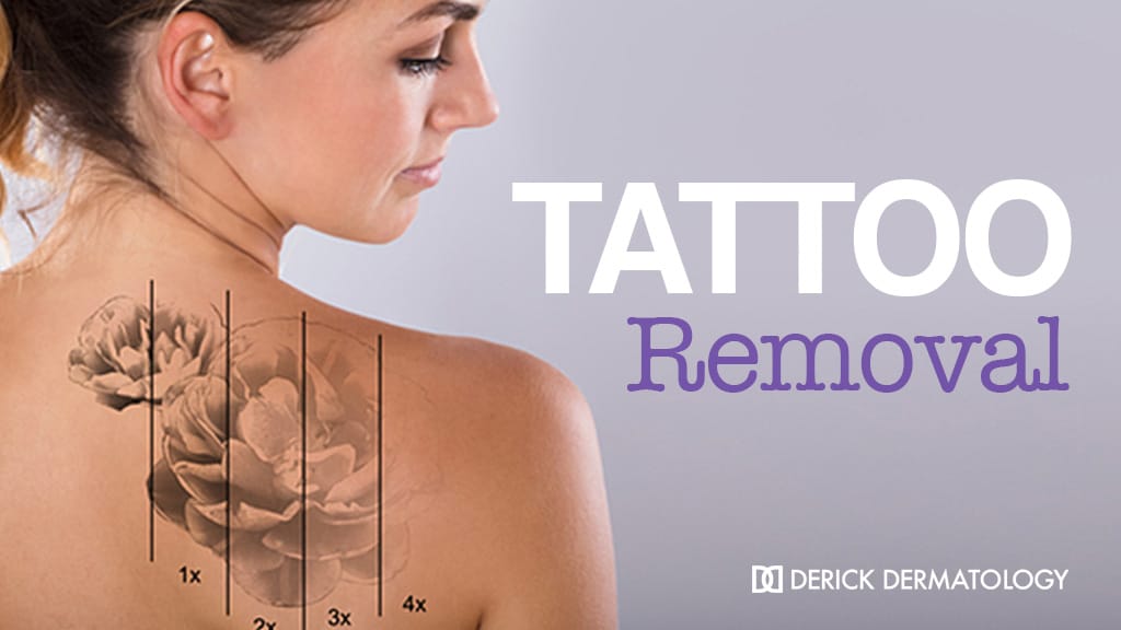 Tattoo Removal, Laser